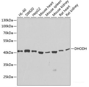Immunohistochemistry of paraffin-embedded Human liver cancer using MLKL Polyclonal Antibody at dilution of  1:100 (40x lens).