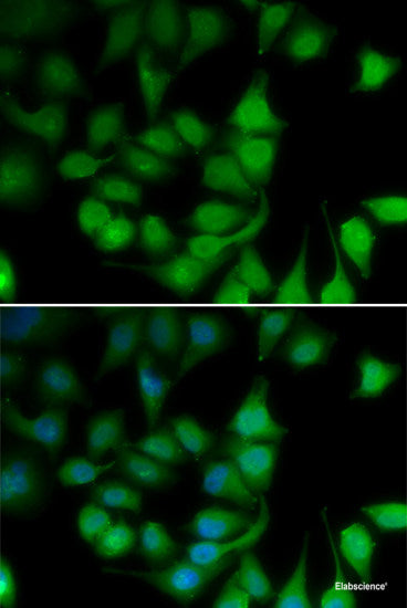Immunohistochemistry of paraffin-embedded Human liver cancer using CYP3A4 Polyclonal Antibody at dilution of  1:100 (40x lens).