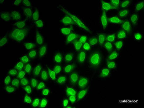 Immunohistochemistry of paraffin-embedded Human lung cancer using FGFR1 Polyclonal Antibody at dilution of  1:100 (40x lens).