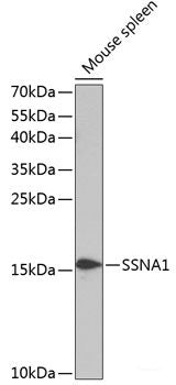 Immunohistochemistry of paraffin-embedded Human lung cancer using MCM5 Polyclonal Antibody at dilution of  1:100 (40x lens).