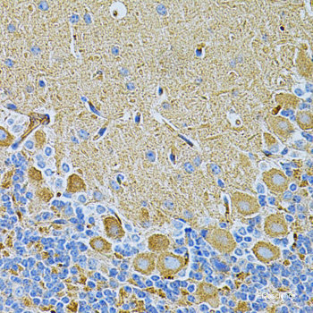 Immunohistochemistry of paraffin-embedded Human esophageal cancer using PPP1CB Polyclonal Antibody at dilution of  1:100 (40x lens).
