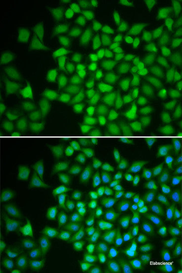 Immunohistochemistry of paraffin-embedded Human liver cancer using UPF1 Polyclonal Antibody at dilution of  1:100 (40x lens).