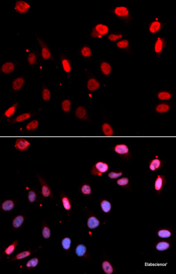Immunohistochemistry of paraffin-embedded Human liver cancer using TIMM17A Polyclonal Antibody at dilution of  1:100 (40x lens).