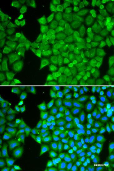 Immunohistochemistry of paraffin-embedded Human liver cancer using KLK10 Polyclonal Antibody at dilution of  1:100 (40x lens).