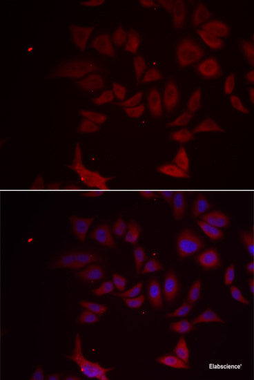 Immunohistochemistry of paraffin-embedded Human lung cancer using ZNF707 Polyclonal Antibody at dilution of  1:100 (40x lens).