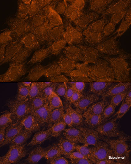 Immunohistochemistry of paraffin-embedded Human lung cancer using ATP1B1 Polyclonal Antibody at dilution of  1:100 (40x lens).