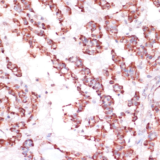 Immunohistochemistry of paraffin-embedded Human mammary cancer using SLC7A2 Polyclonal Antibody at dilution of  1:100 (40x lens).