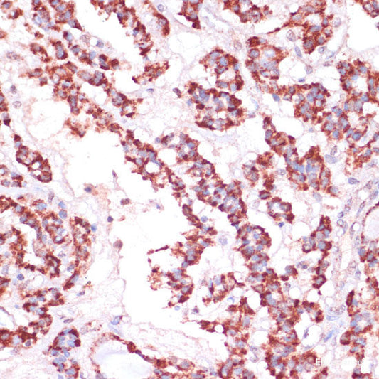 Immunohistochemistry of paraffin-embedded Human mammary cancer using SLC7A2 Polyclonal Antibody at dilution of  1:100 (40x lens).