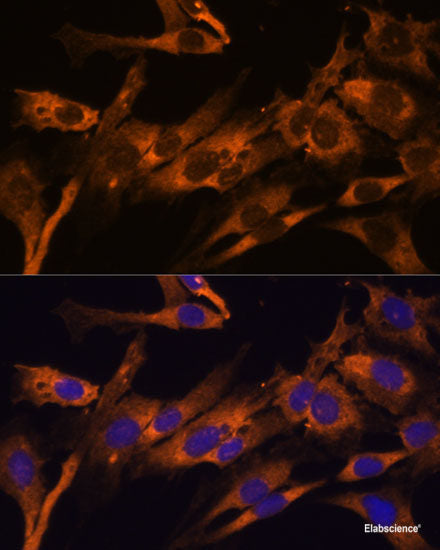 Immunohistochemistry of paraffin-embedded Human uterine cancer using IFT57 Polyclonal Antibody at dilution of  1:100 (40x lens).