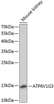 Immunohistochemistry of paraffin-embedded Human gastric cancer using CDH11 Polyclonal Antibody at dilution of  1:100 (40x lens).