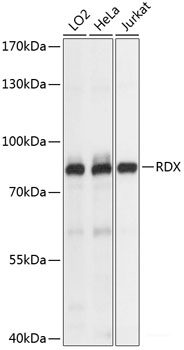 Immunohistochemistry of paraffin-embedded Human lung cancer using CTTN Polyclonal Antibody at dilution of  1:100 (40x lens).
