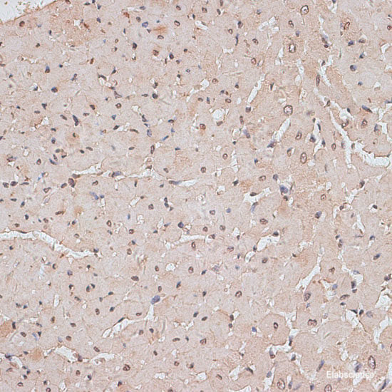 Immunofluorescence analysis of Human kidney cancer using SCNN1G Polyclonal Antibody at dilution of  1:100. Blue: DAPI for nuclear staining.