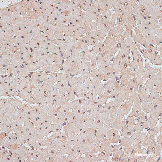 Immunofluorescence analysis of Human kidney cancer using SCNN1G Polyclonal Antibody at dilution of  1:100. Blue: DAPI for nuclear staining.