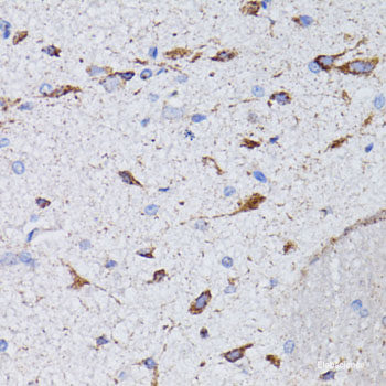 Immunohistochemistry of paraffin-embedded Human lung cancer using CD47 Polyclonal Antibody at dilution of  1:200 (40x lens).