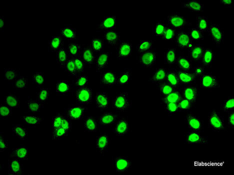 Immunohistochemistry of paraffin-embedded Human thyroid cancer using CFLAR Polyclonal Antibody at dilution of  1:100 (40x lens).