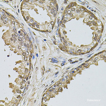 Immunohistochemistry of paraffin-embedded Human lung cancer using NELFE Polyclonal Antibody at dilution of  1:100 (40x lens).