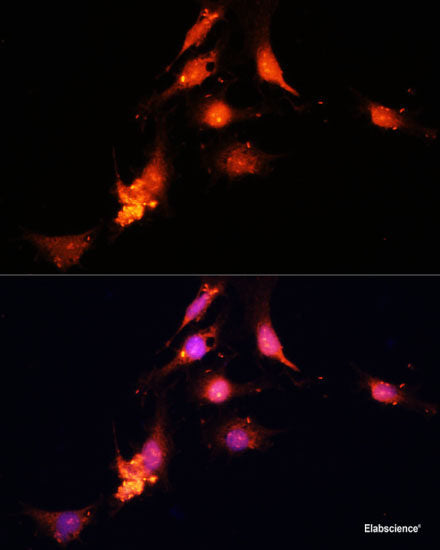 Immunohistochemistry of paraffin-embedded Human esophageal cancer using PARN Polyclonal Antibody at dilution of  1:100 (40x lens).