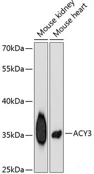 Immunohistochemistry of paraffin-embedded Human liver cancer using RIP3 Polyclonal Antibody at dilution of  1:100 (40x lens).