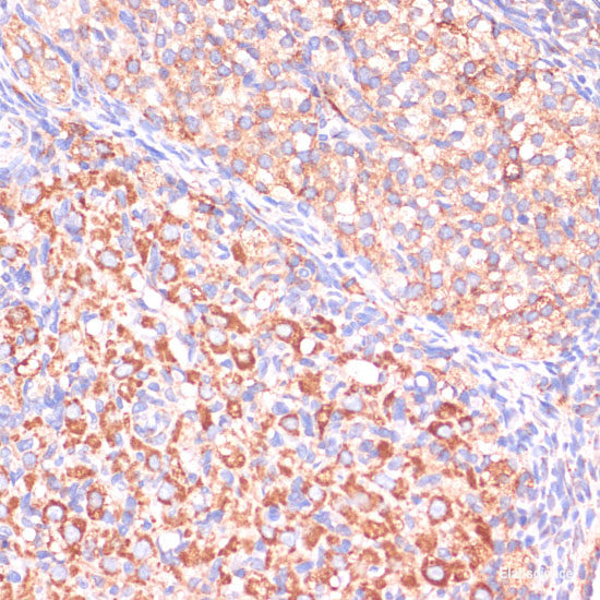 Immunohistochemistry of paraffin-embedded Human liver cancer using YAP1 Polyclonal Antibody at dilution of  1:100 (40x lens).