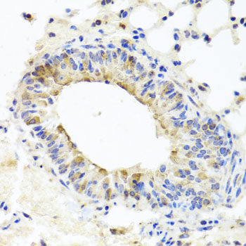 Immunohistochemistry of paraffin-embedded Human lung cancer using MMP16 Polyclonal Antibody at dilution of  1:100 (40x lens).