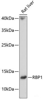Immunohistochemistry of paraffin-embedded Human breast cancer using CTSF Polyclonal Antibody at dilution of  1:100 (40x lens).