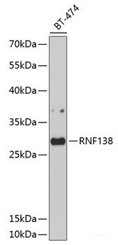 Immunofluorescence analysis of Human liver cancer using AFP Polyclonal Antibody at dilution of  1:100. Blue: DAPI for nuclear staining.
