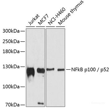 Immunohistochemistry of paraffin-embedded Human mammary cancer using ACSL3 Polyclonal Antibody at dilution of  1:100 (40x lens).