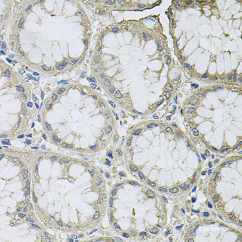 Immunohistochemistry of paraffin-embedded Human lung cancer using KL Polyclonal Antibody at dilution of  1:200 (40x lens).