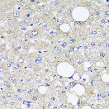 Immunohistochemistry of paraffin-embedded Human liver cancer using AFP Monoclonal Antibody at dilution of  1:12.5 (40x lens).