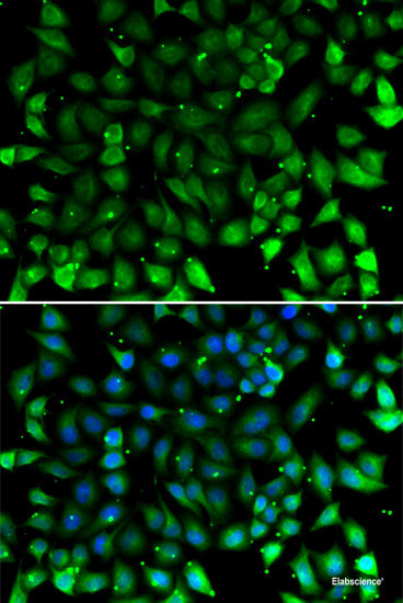 Immunohistochemistry of paraffin-embedded Human kidney cancer using Syndecan-1 Polyclonal Antibody at dilution of  1:200 (40x lens).