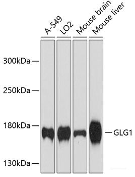 Immunofluorescence analysis of Human liver cancer using F2 Polyclonal Antibody at dilution of  1:100. Blue: DAPI for nuclear staining.