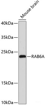 Immunohistochemistry of paraffin-embedded Human liver cancer using CHAT Polyclonal Antibody at dilution of  1:200 (40x lens).