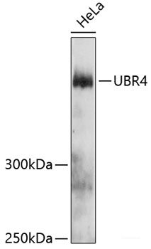 Immunohistochemistry of paraffin-embedded Human colon carcinoma using TIA1 Polyclonal Antibody at dilution of  1:100 (40x lens).