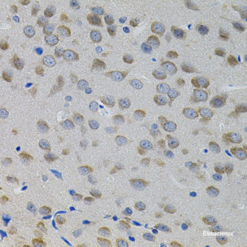 Immunohistochemistry of paraffin-embedded Human liver cancer using RASSF1 Polyclonal Antibody at dilution of  1:100 (40x lens).