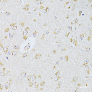 Immunohistochemistry of paraffin-embedded Human lung cancer using CDCA8 Polyclonal Antibody at dilution of  1:100 (40x lens).