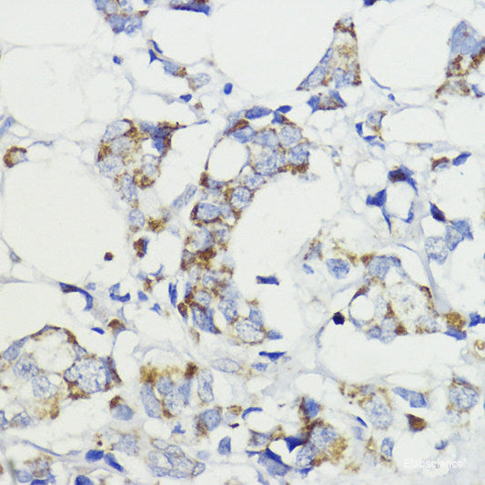 Immunohistochemistry of paraffin-embedded Human mammary cancer using PGK2 Polyclonal Antibody at dilution of  1:100 (40x lens).