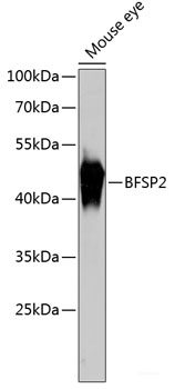 Immunohistochemistry of paraffin-embedded Human breast cancer using ARRB2 Polyclonal Antibody at dilution of  1:200 (40x lens).