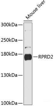 Immunohistochemistry of paraffin-embedded Human gastric cancer using DR1 Polyclonal Antibody at dilution of  1:100 (40x lens).