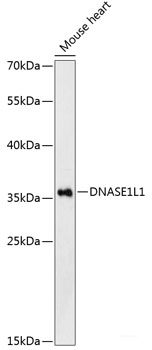 Immunohistochemistry of paraffin-embedded Human liver cancer using FSCN1 Polyclonal Antibody at dilution of  1:100 (40x lens).