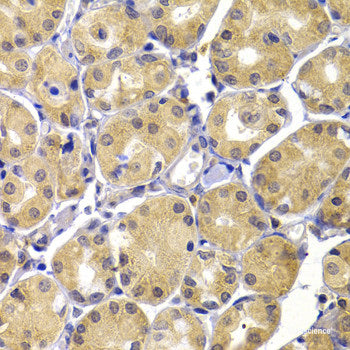 Immunohistochemistry of paraffin-embedded Human mammary cancer using VTN Polyclonal Antibody at dilution of  1:100 (40x lens).