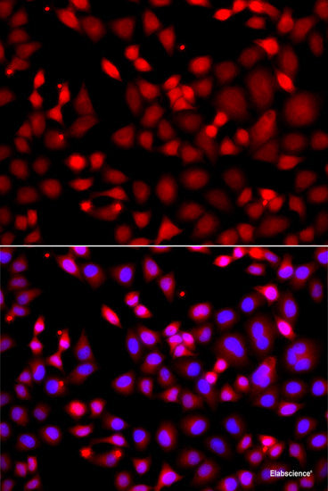 Immunohistochemistry of paraffin-embedded Human liver cancer using RPH3A Polyclonal Antibody at dilution of  1:100 (40x lens).