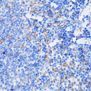 Immunohistochemistry of paraffin-embedded Human gastric cancer using GCLM Polyclonal Antibody at dilution of  1:100 (40x lens).