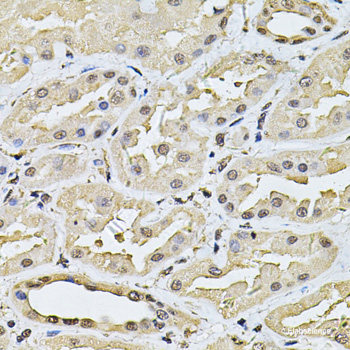 Immunohistochemistry of paraffin-embedded Human thyroid cancer using RPL24 Polyclonal Antibody at dilution of  1:100 (40x lens).