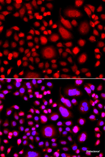 Immunohistochemistry of paraffin-embedded Human lung cancer using ASCL4 Polyclonal Antibody at dilution of  1:100 (40x lens).
