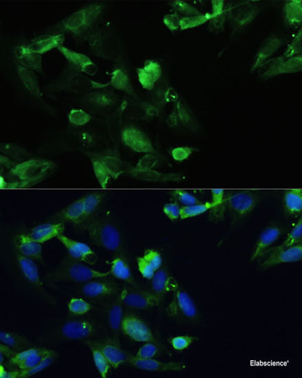 Immunohistochemistry of paraffin-embedded Human lung cancer using HTATSF1 Polyclonal Antibody at dilution of  1:100 (40x lens).