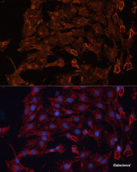 Immunohistochemistry of paraffin-embedded Human gastric cancer using ZEB1 Polyclonal Antibody at dilution of  1:200 (40x lens).
