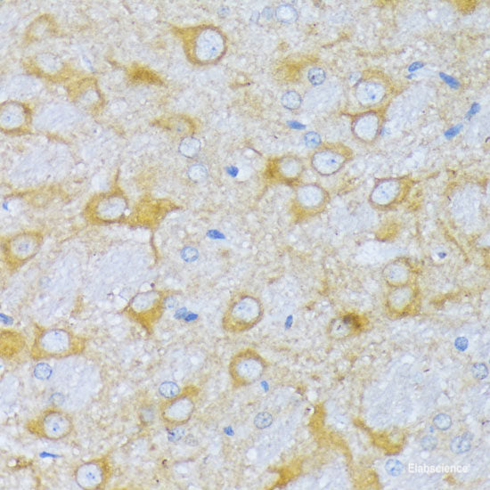 Immunohistochemistry of paraffin-embedded Human lung cancer using ZDHHC18 Polyclonal Antibody at dilution of  1:100 (40x lens).