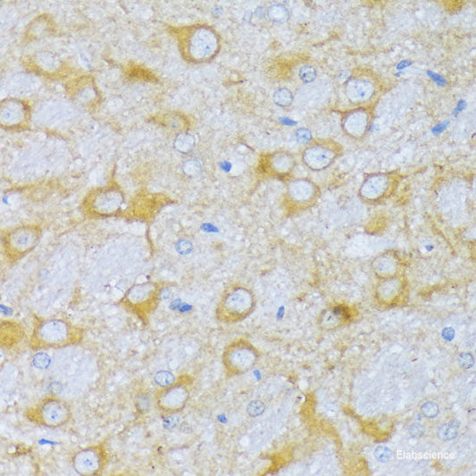 Immunohistochemistry of paraffin-embedded Human lung cancer using ZDHHC18 Polyclonal Antibody at dilution of  1:100 (40x lens).
