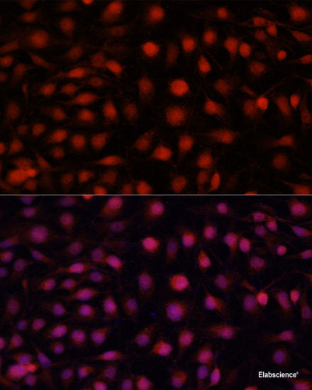 Immunohistochemistry of paraffin-embedded Human lung cancer using RNASE6 Polyclonal Antibody at dilution of  1:100 (40x lens).