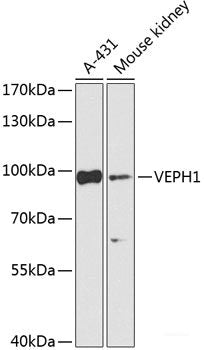 Immunohistochemistry of paraffin-embedded Human liver cancer using PRR11 Polyclonal Antibody at dilution of  1:100 (40x lens).
